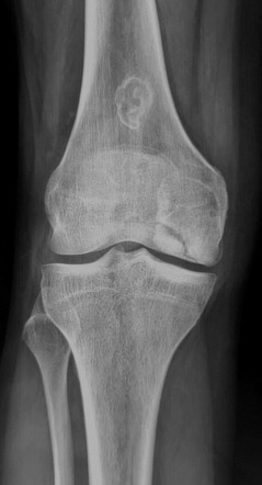 Osteochondritis dissecans of the knee | Radiology Case | Radiopaedia.org