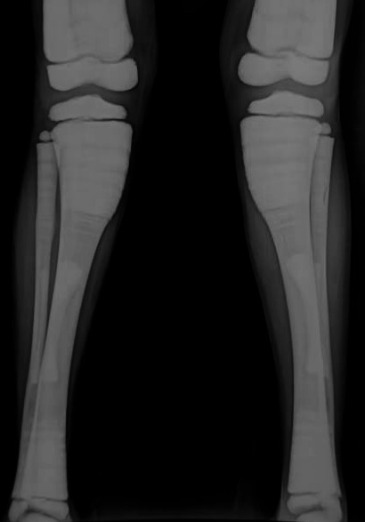 Osteopetrosis | Image | Radiopaedia.org