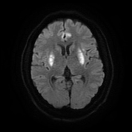 Carbon monoxide poisoning | Radiology Reference Article | Radiopaedia.org