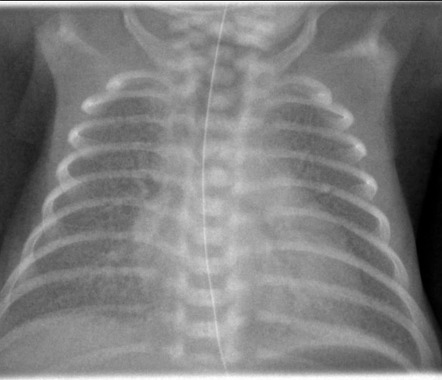 Neonatal respiratory distress syndrome | Radiology Case | Radiopaedia.org