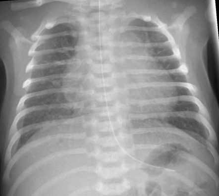 Transient Tachypnea Of The Newborn | Radiology Case | Radiopaedia.org