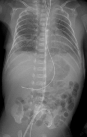 Malpositioned umbilical vein catheter - too high | Radiology Case ...