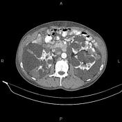 Autosomal dominant polycystic kidney disease, Radiology Reference Article