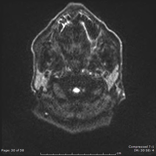 Progressive Supranuclear Palsy | Image | Radiopaedia.org