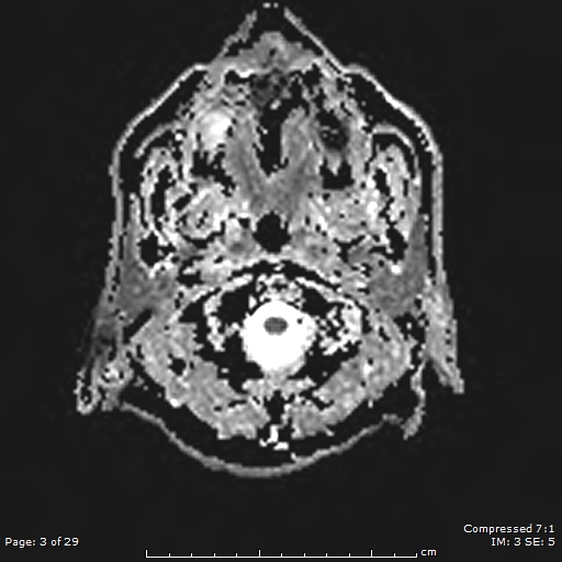 Progressive Supranuclear Palsy | Image | Radiopaedia.org