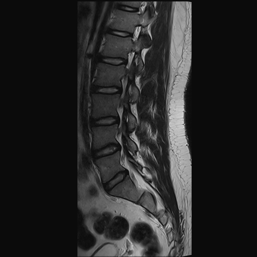 Spinal schwannoma | Image | Radiopaedia.org