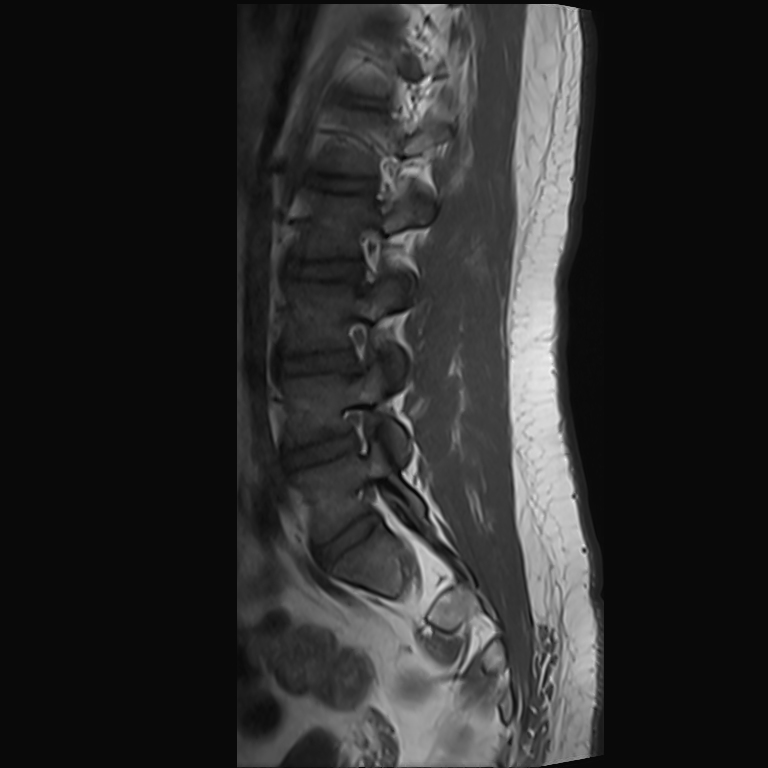 Spinal schwannoma | Image | Radiopaedia.org