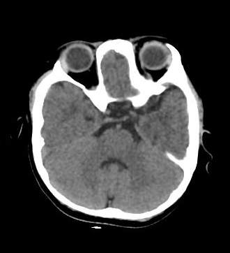 Frontal plagiocephaly | Image | Radiopaedia.org