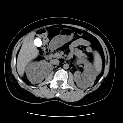 Cholelithiasis | Image | Radiopaedia.org