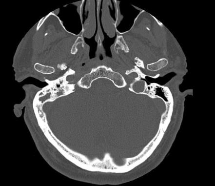 Cholesteatoma | Radiology Case | Radiopaedia.org