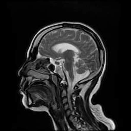 Dyke–Davidoff–Masson syndrome with crossed cerebellar atrophy | Image ...