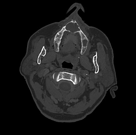 Incisive canal cyst | Radiology Case | Radiopaedia.org