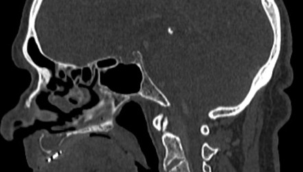 Incisive canal cyst | Image | Radiopaedia.org