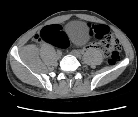 Pelvic bucket handle fracture | Image | Radiopaedia.org