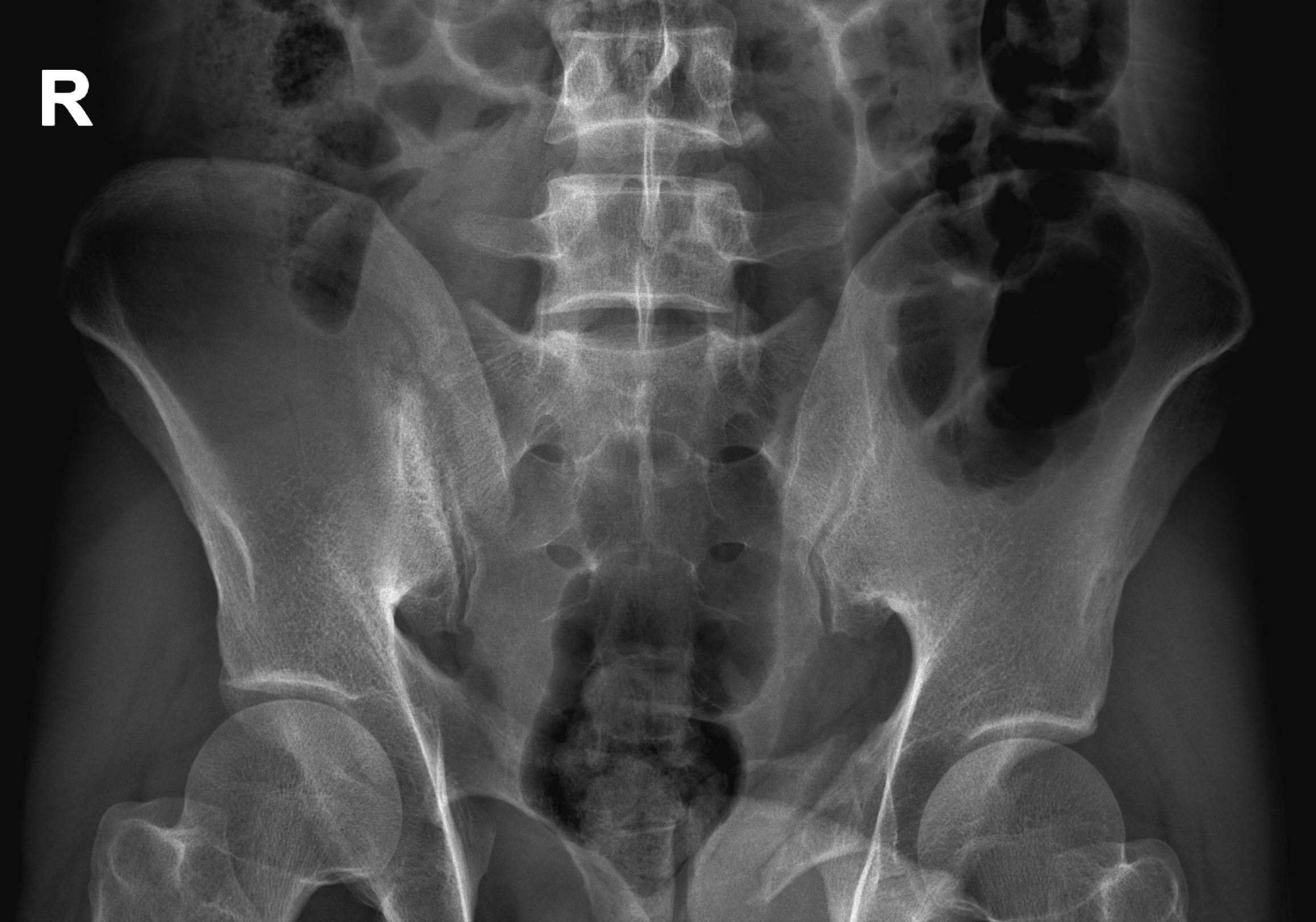 Pelvic bucket handle fracture | Image | Radiopaedia.org