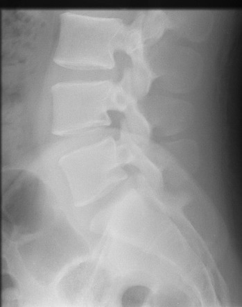 Spinal schwannoma | Image | Radiopaedia.org