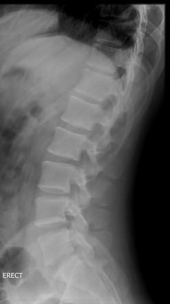 Spinal schwannoma | Image | Radiopaedia.org