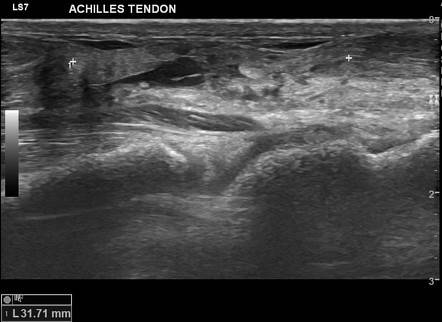 Achilles tendon tear | Radiology Case | Radiopaedia.org