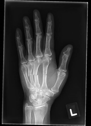 Multiple metacarpal fractures | Radiology Case | Radiopaedia.org