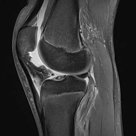 Popliteus injury | Radiology Reference Article | Radiopaedia.org