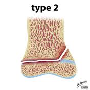 Salter-Harris classification | Radiology Reference Article ...