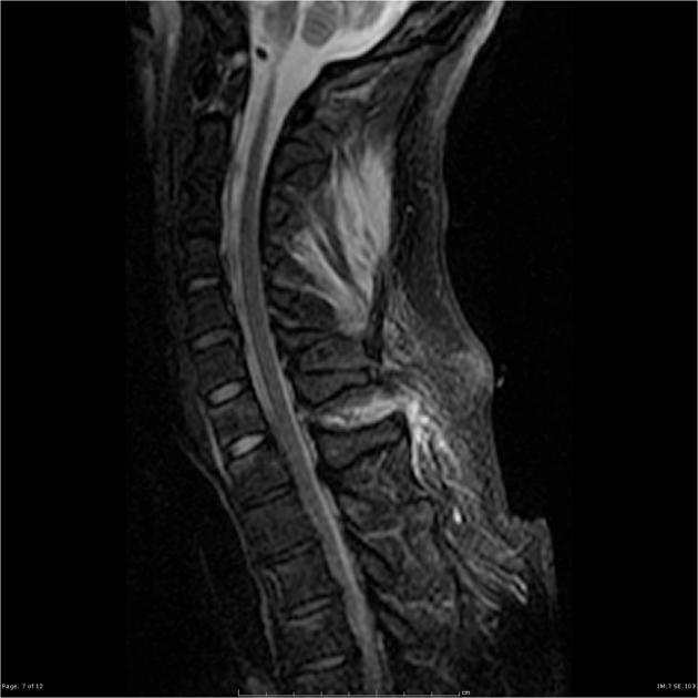 Post Traumatic Ligamentum Flavum Tear Radiology Case Radiopaedia Org