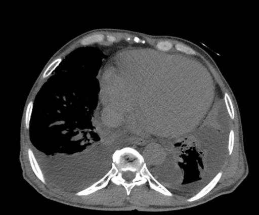 Cardiogenic pulmonary edema | Image | Radiopaedia.org