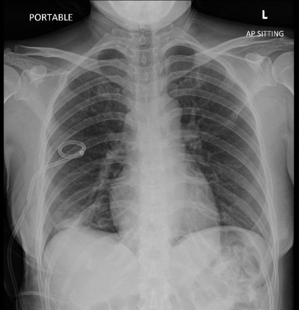 Basal pneumothorax Radiology Case Radiopaedia