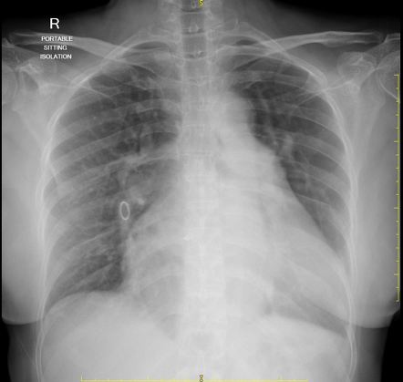 Amplatzer atrial septal defect occluder device | Radiology Case ...