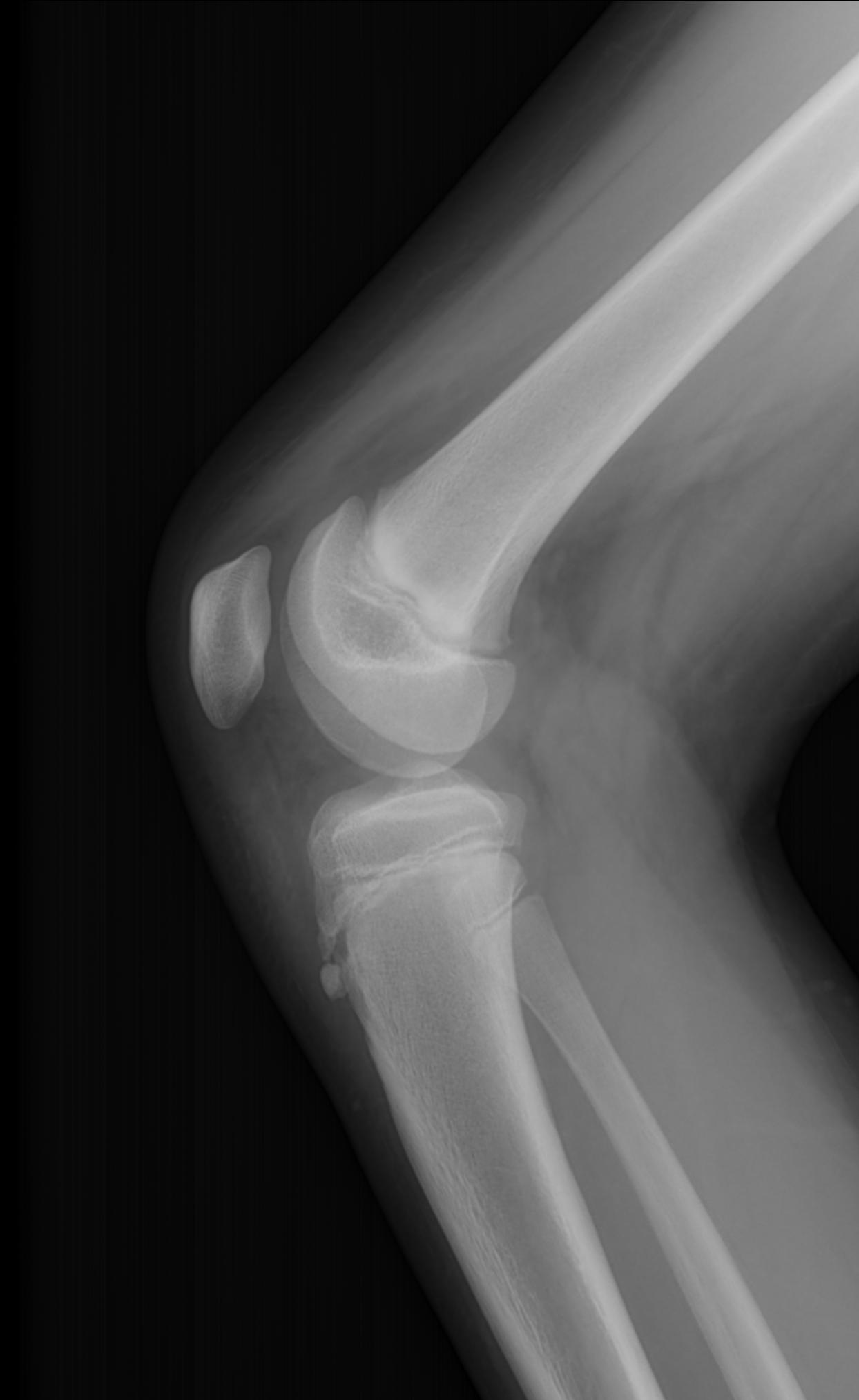 Osgood Schlatter Disease Image