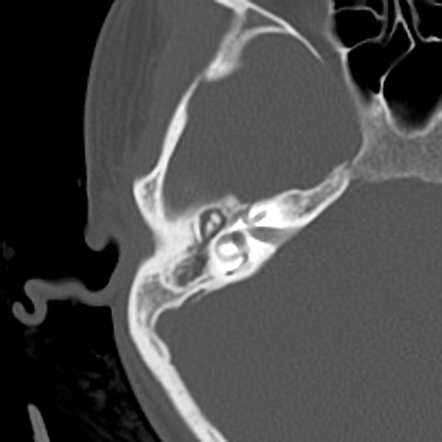 acute otitis media case study