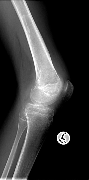 Chondroblastoma Radiology Case Radiopaedia