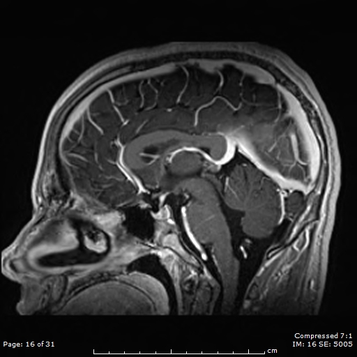 Brain Herniation Into The Right Transverse Dural Sinuses Image Radiopaedia Org