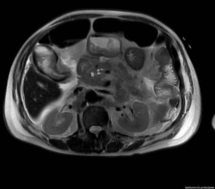 Acute hemorrhagic cholecystitis and pancreatitis secondary to a ...