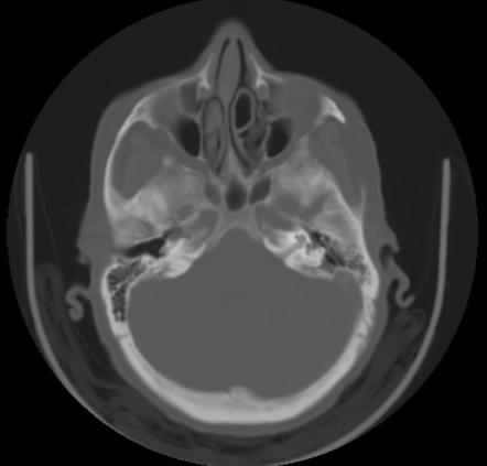 Concha bullosa | Radiology Reference Article | Radiopaedia.org