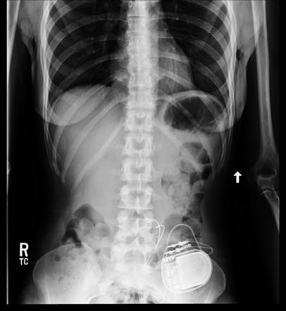 Medical devices in the abdomen and pelvis | Radiology Reference Article ...