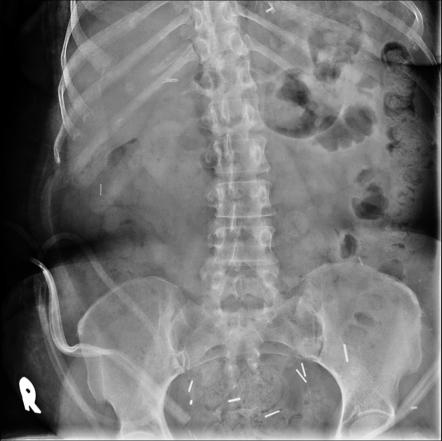 Breast reconstruction with TRAM flap | Radiology Case | Radiopaedia.org