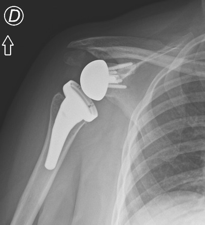 Non-traumatic acromial fracture after reverse shoulder arthroplasty ...