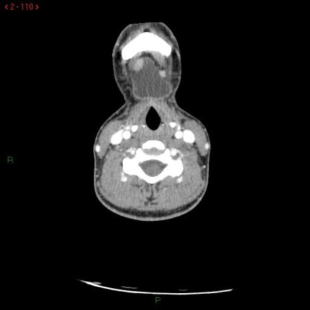 Thyroglossal Duct Cyst | Radiology Case | Radiopaedia.org