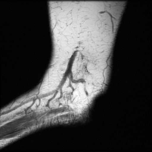 Haglund Syndrome | Image | Radiopaedia.org