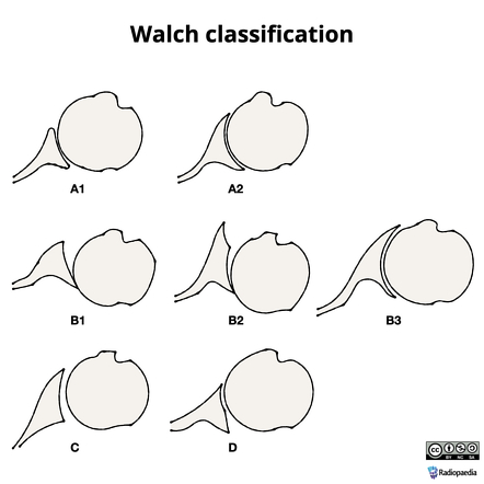 Walch classification of glenoid morphology | Radiology Reference ...