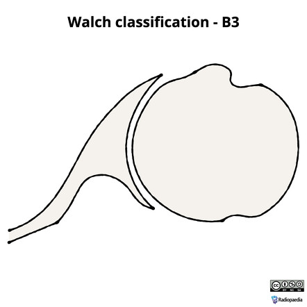 Radiology Glenoid Classification Fossa Drawings Fractures ...