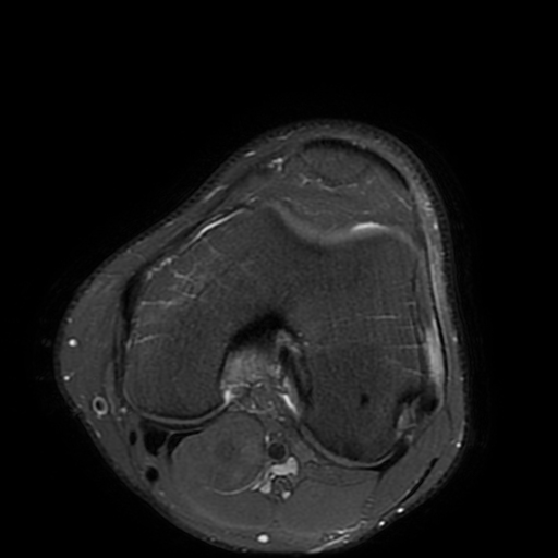 Iliotibial band friction syndrome | Image | Radiopaedia.org