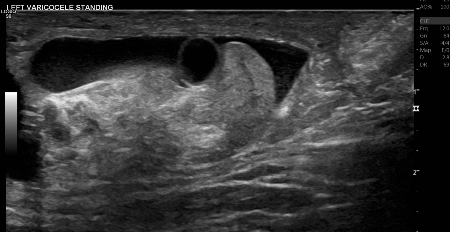 Cystic appendix epididymis | Image | Radiopaedia.org