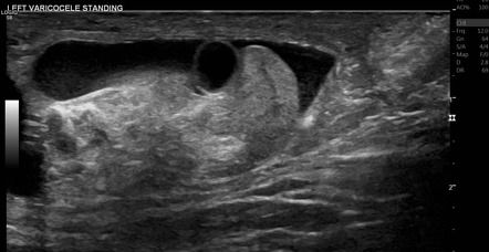 Cystic appendix epididymis | Radiology Case | Radiopaedia.org