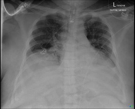 Foreign body | Radiology Reference Article | Radiopaedia.org