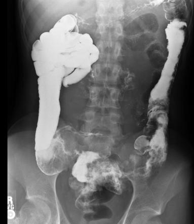 Crohn disease | Radiology Case | Radiopaedia.org