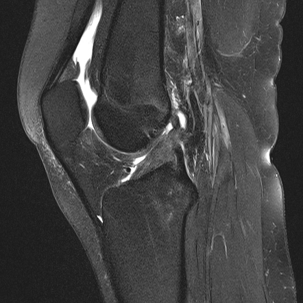 Anterior cruciate ligament rupture - isolated | Radiology Case ...