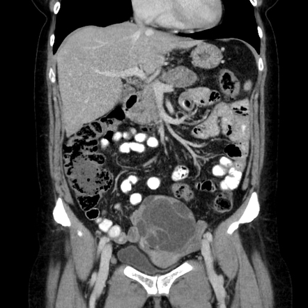 Pancreatic body/tail adenocarcinoma with ovarian metastases | Radiology ...