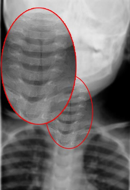 Steeple sign (trachea), Radiology Reference Article